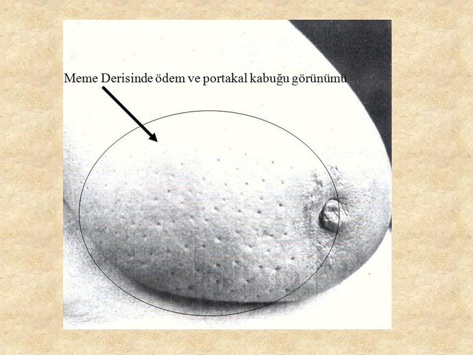 Meme Kanseri Nedir? #MemeKanseriFarkındalıkAyı