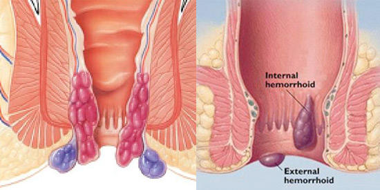Gizlenen Hastalık Hemoroid