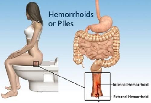 Hemoroid Ağrılarımdan Nasıl Kurtuldum?