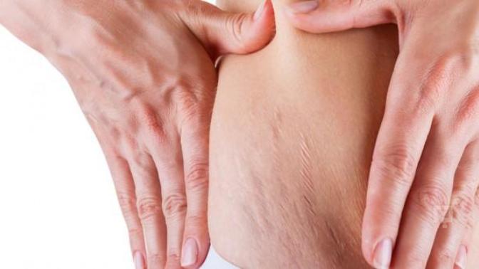 Kadınlarda Cilt Çatlakları – Coğrafyayı Değiştiren Hastalık