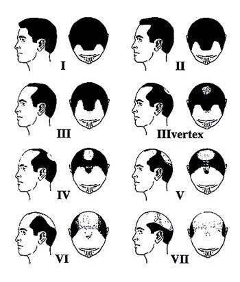 Erkek Tipi Saç Dökülmesi - Androgenetik Alopesi