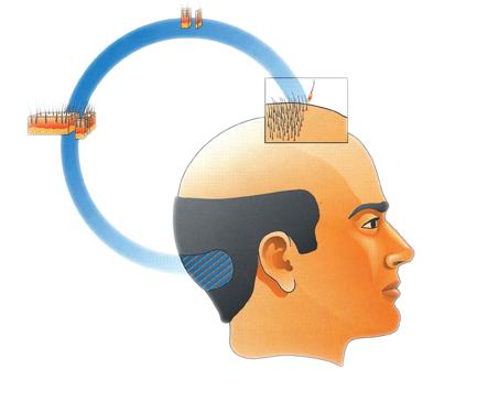 Erkek Tipi Saç Dökülmesi - Androgenetik Alopesi