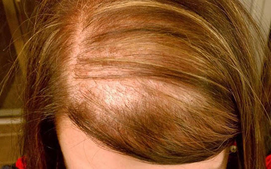 Erkek Tipi Saç Dökülmesi - Androgenetik Alopesi