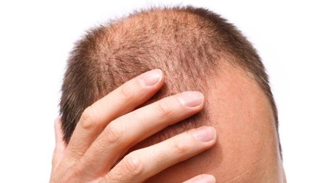 Erkek Tipi Saç Dökülmesi - Androgenetik Alopesi