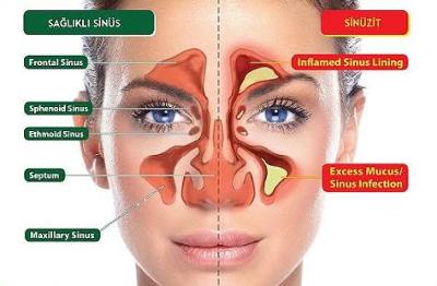 Sinuziti Neler Tetikliyor Sinuziti Neler Tetikliyor