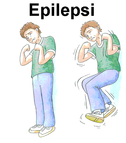 Epilepsi İle Yaşam (Beyinde Elektrik Boşalması)