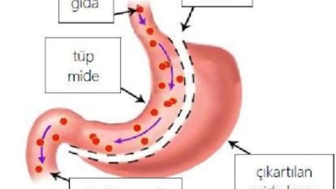 110 Kilo Verdiğim Maceramda Tüp Mide Operasyonu ve Deneyimlerim