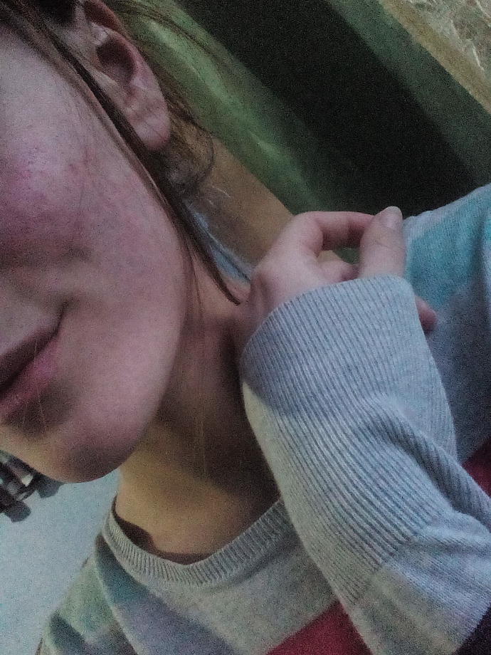 Sivilceler mi? Çare Roaccutane