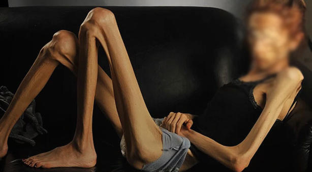 Bulimia ve Anoreksiya Hastalığını Tanıyalım