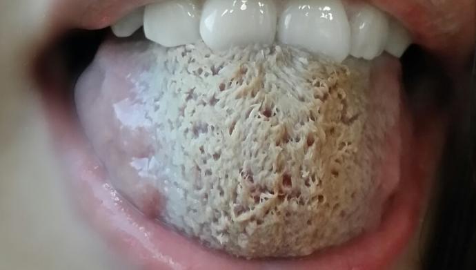 Tuhaf Bir Fobi: Trypophobia