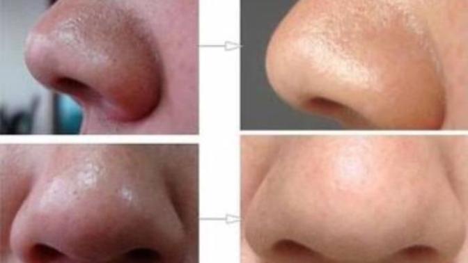 Burnunuzdaki Siyah Noktalardan Bu Pratik Maske ile Kurtulabilirsiniz