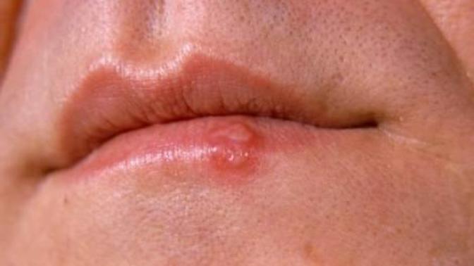 Uçuk (Herpes) Tedavi Yöntemleri