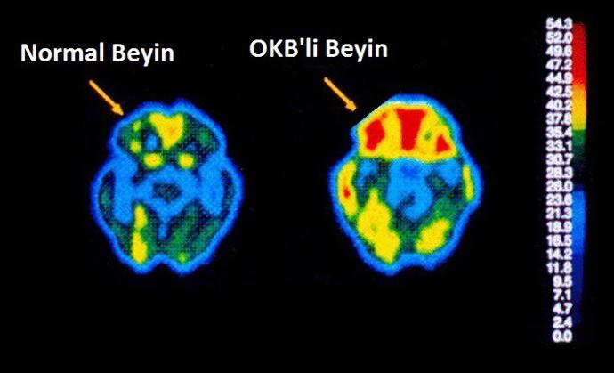 OKB Destek! Obsesif Kompulsif Bozukluk Nedir? Nasıl Tedavi Edilir? Bilişsel Terapinin Önemi
