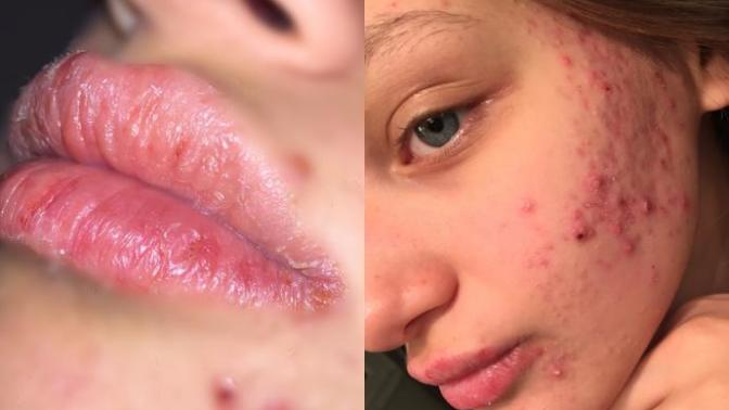 Roaccutane Kullanırken Yardım Aldığım Ürünler
