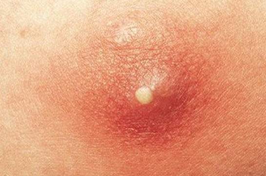 Terlemenin İnsan Sağlığı Üzerindeki Zararları