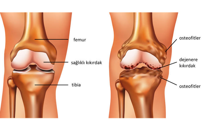 Fazla Kiloların Neden Olabileceği Hastalıklar