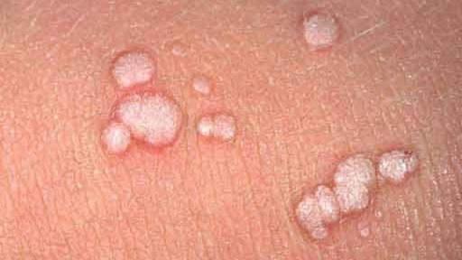 Cinsel Hastalık Türü: Genital Siğiller ve Tavsiyeler
