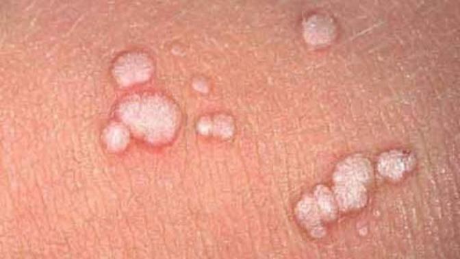 Genital Siğiller Hakkında Tavsiyeler