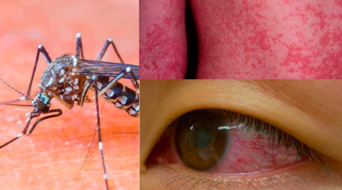 Zika Virüsü Nedir?