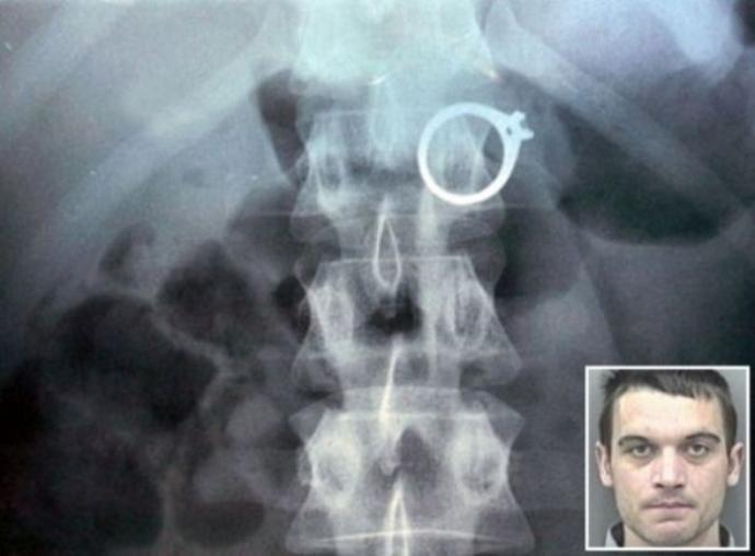 Röntgen Çekiminde İnsanların Vücutlarında Bulunan İlginç Objeler