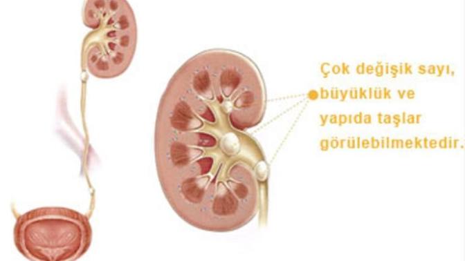 Böbrek Taşı Nedenleri ve Taştan Kurtulma Yolları