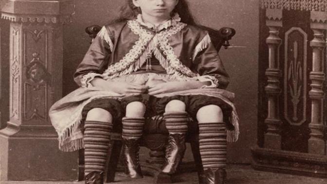 Myrtle Corbin ve Bacakları!