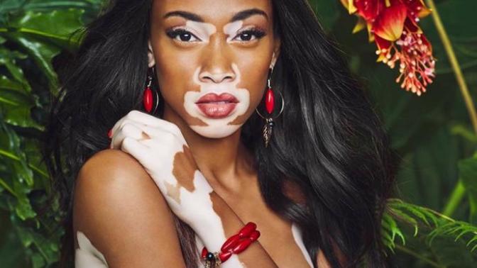 Bazen Kusurlar Avantajdır, Winnie Harlow Bunun Örneği!