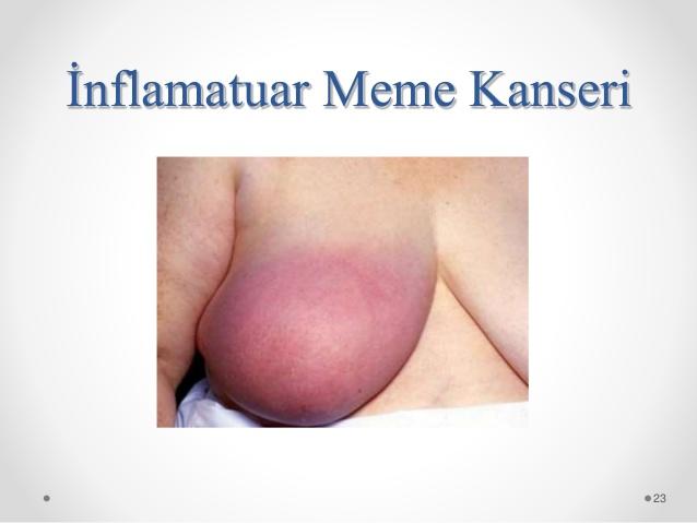 Erkeklerde Meme Kanseri Olur mu?