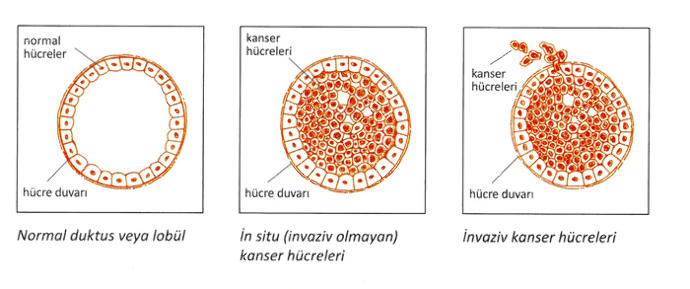 Erkeklerde Meme Kanseri Olur mu?