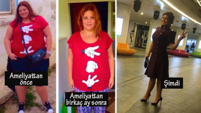 Tüp Mide Ameliyat Günlüğüm ( Ameliyat Öncesi/ Sonrası Süreç )