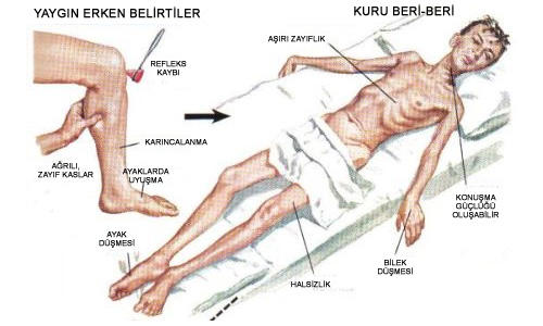İskorbüt Hastalığı Nedir?