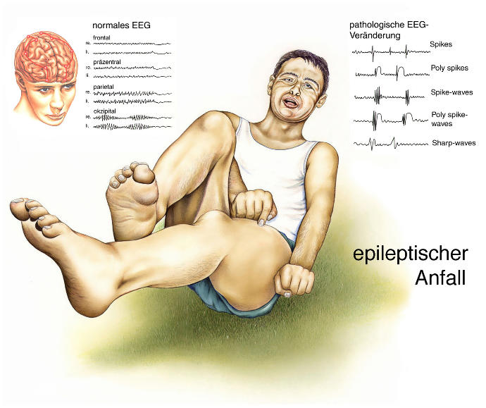 Epilepsi Nedir? Epilepsi Hakkında Bilinmesi Gerekenler