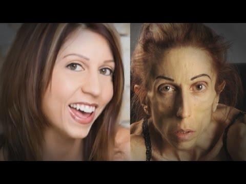 Bir Anorexia Vakası Daha; Rachael Farrokh
