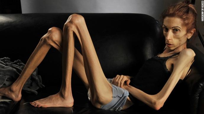 Bir Anorexia Vakası Daha; Rachael Farrokh