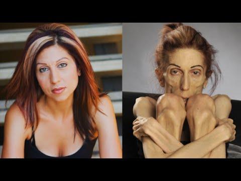Bir Anorexia Vakası Daha; Rachael Farrokh