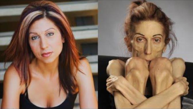Bir Anorexia Vakası Daha; Rachael Farrokh