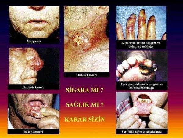Sigarayı Bırakmanıza Yardımcı Olacak, Rahatsız Edici Reklamlar!