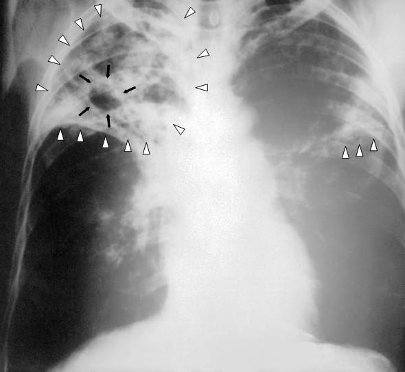 Tüberküloz (Verem) Nedir?