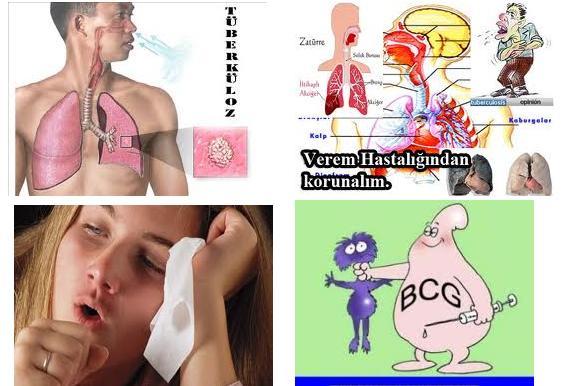Tüberküloz (Verem) Nedir?
