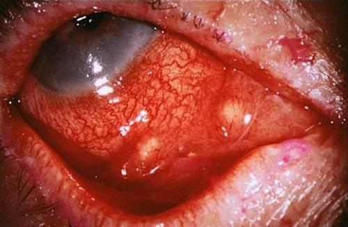 Tularemi Nedir? Belirtileri Nelerdir?