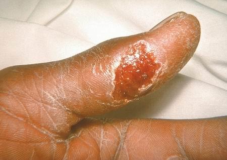 Tularemi Nedir? Belirtileri Nelerdir?