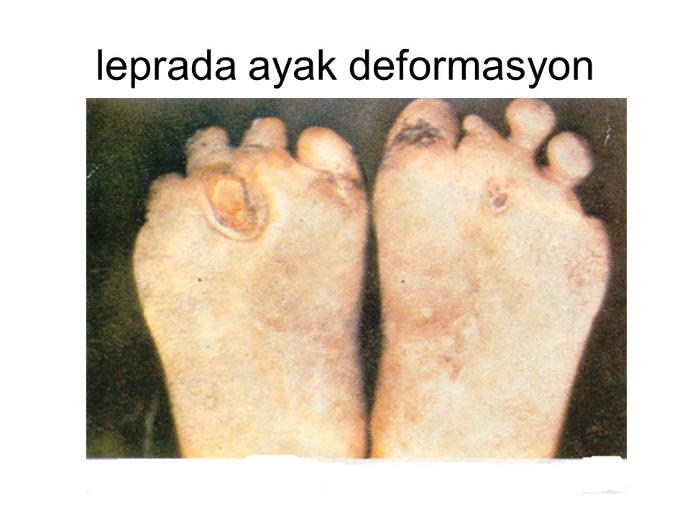 Lepra'nın Hayatımıza Vereceği Zararlar