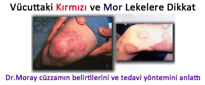 Lepra'nın Hayatımıza Vereceği Zararlar