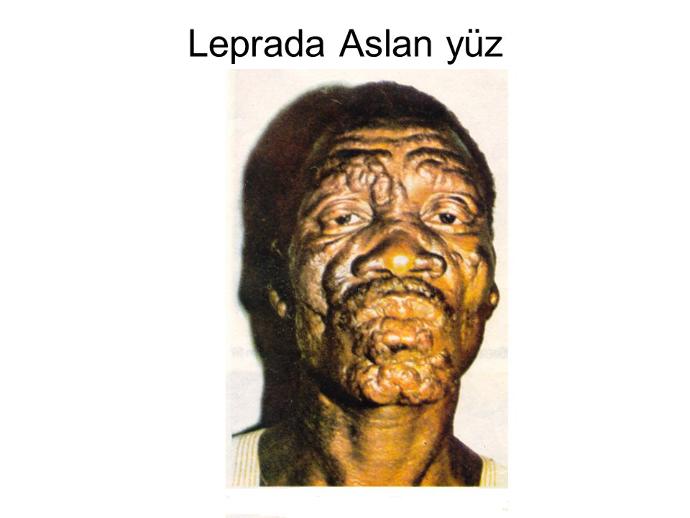 Lepra'nın Hayatımıza Vereceği Zararlar