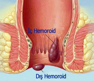 Çağımızın Hastalığı Hemoroid (Basur) Tedavisi