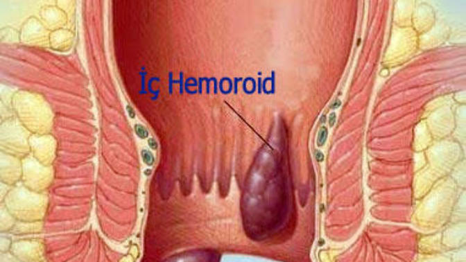 Çağımızın Hastalığı Hemoroid (Basur) Tedavisi