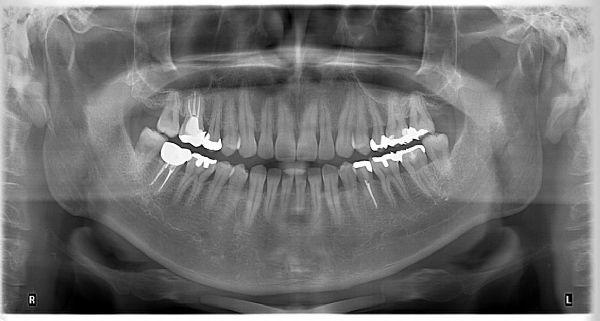 Kanal Tedavisi: Endodonti
