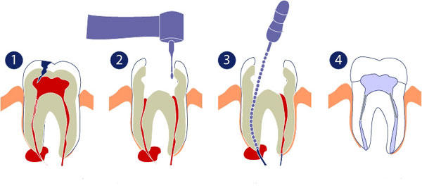 Kanal Tedavisi: Endodonti
