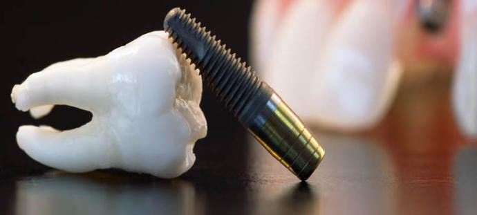 Kanal Tedavisi: Endodonti