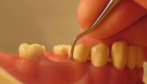 Diş Eti Hastalıkları: Periodontoloji